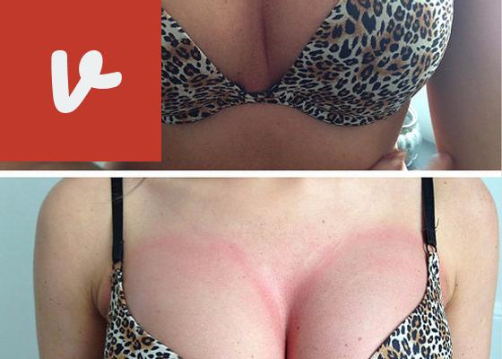 Discover the Transformational Results of Breast Cupping