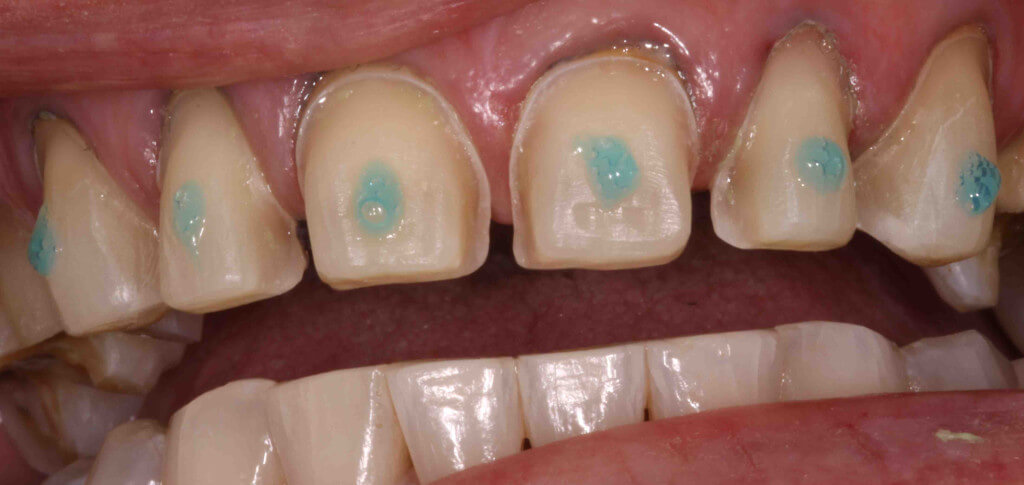 3. What is the Proper Way to Prepare a Tooth for Veneer Placement? 