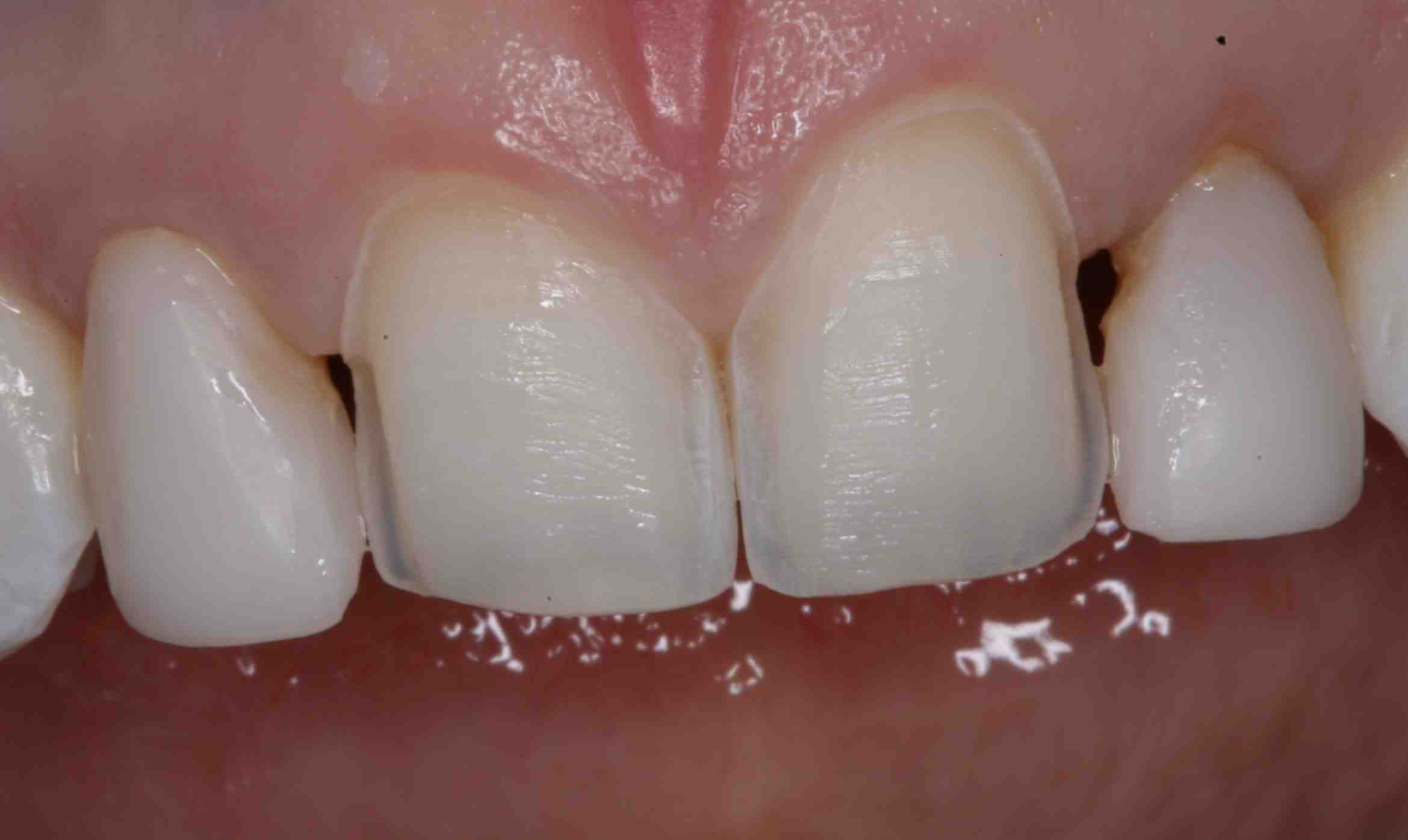 3. Benefits of Teeth Prep for Veneers: Why You Should Do It 