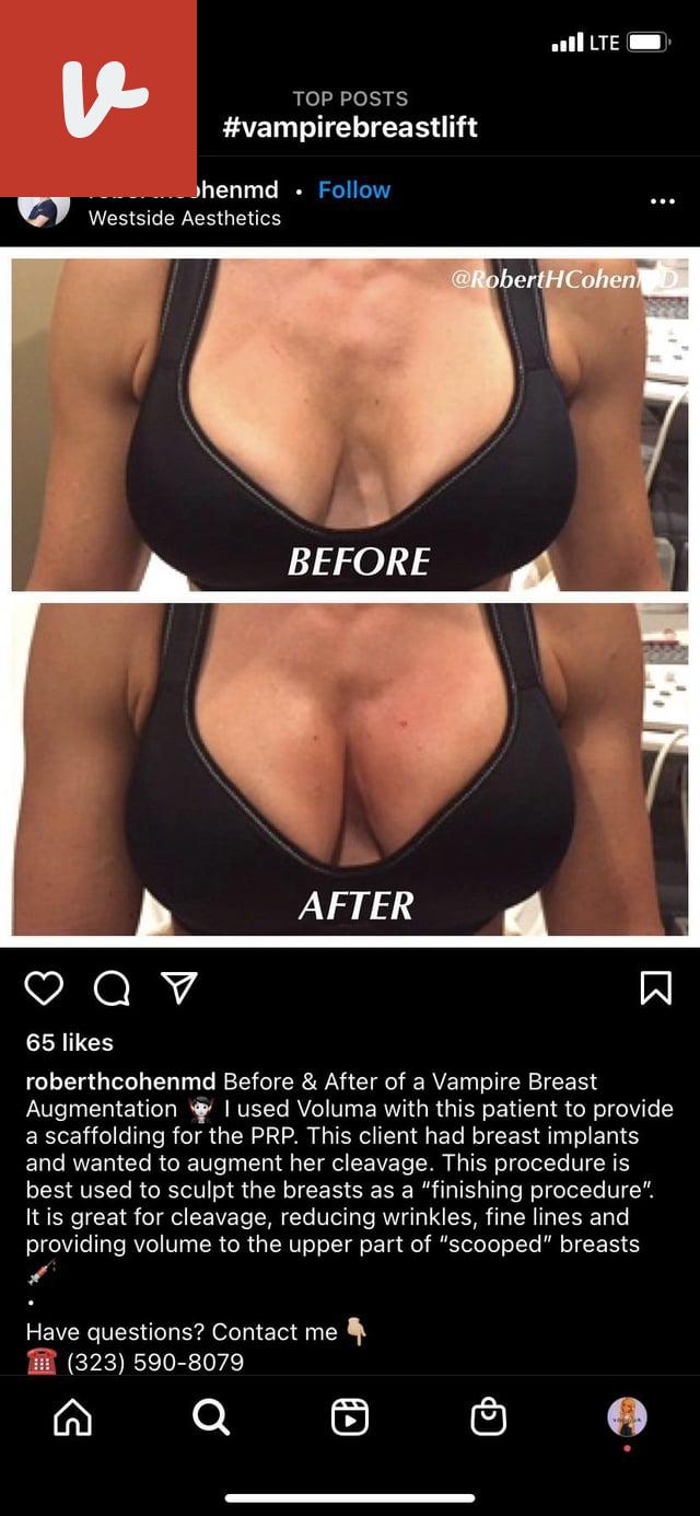 vampire breast lift reddit
