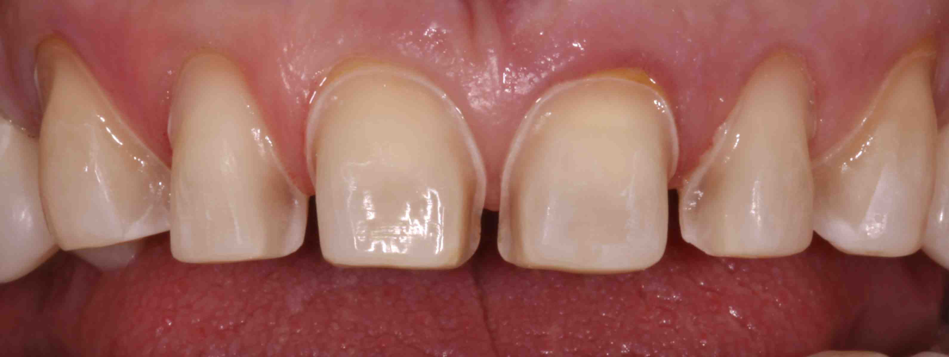 3. Optimizing Your Teeth for Veneer Preparations: Tips and Tricks 