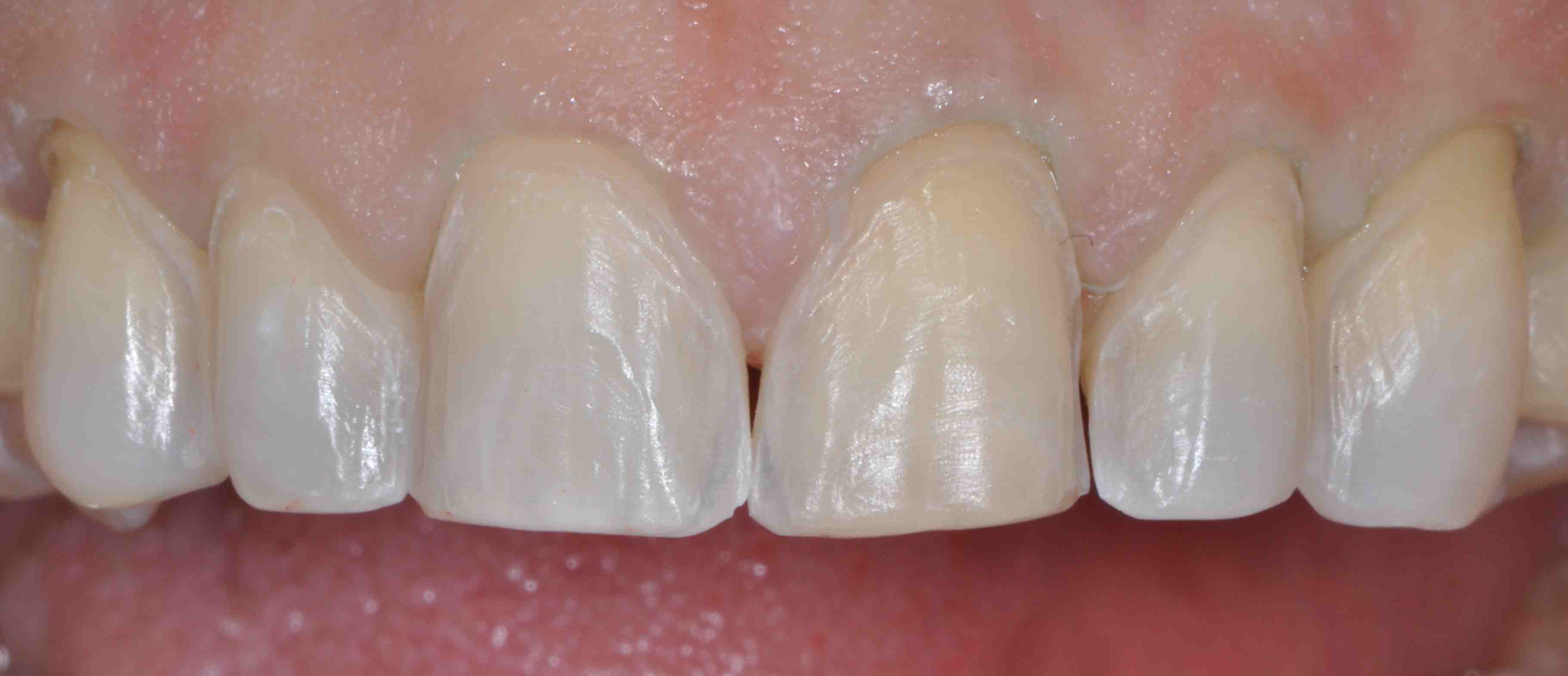 3. Understanding the Benefits of Veneer Teeth Prep 