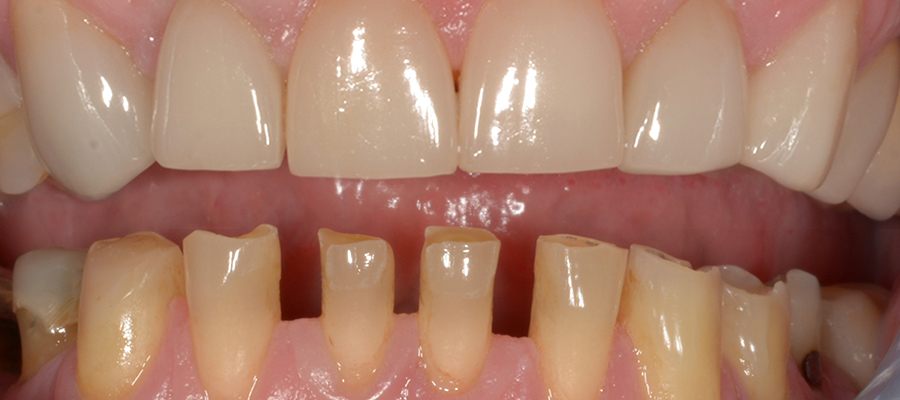 Why Proper Teeth Preparation is Essential Before Veneers