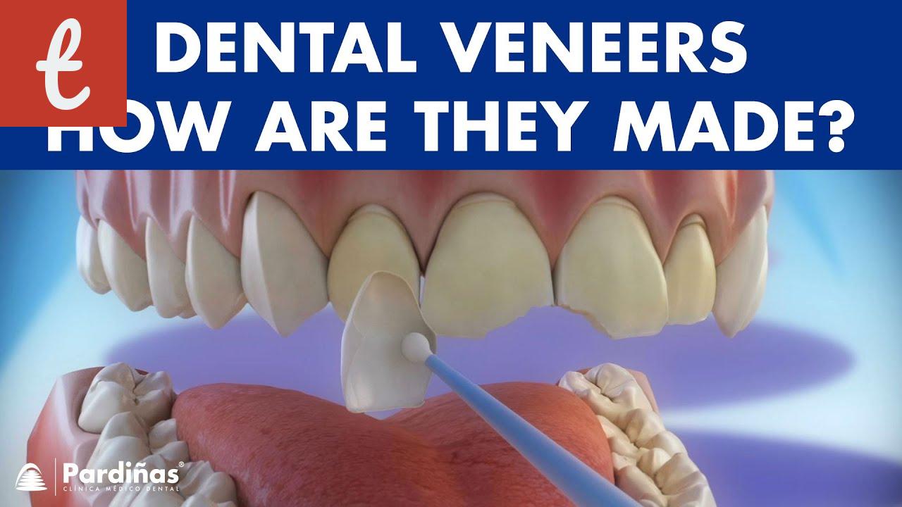 how to make veneer teeth